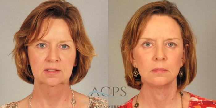 Before & After Facelift Case 1266 Front View: View in Houston, TX