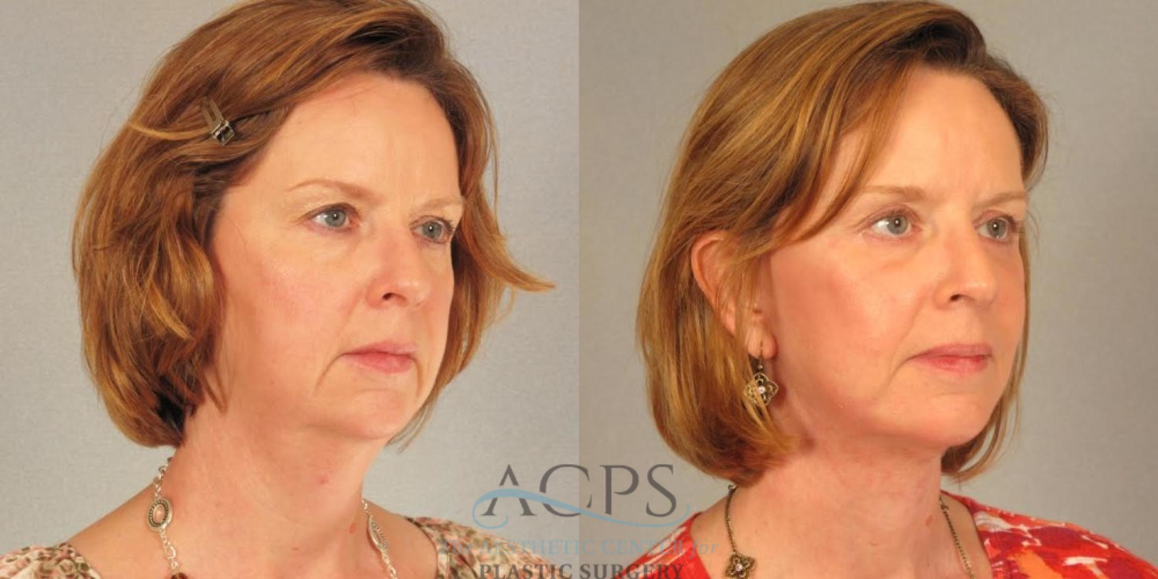 Before & After Facelift Case 1266 Oblique View: View in Houston, TX