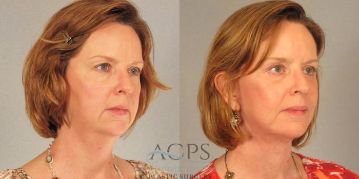 Before & After Facelift Case 1266 Oblique View: View in Houston, TX