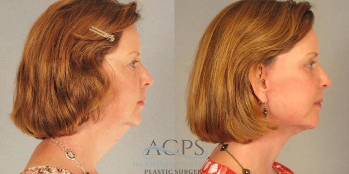 Before & After Facelift Case 1266 Side View: View in Houston, TX