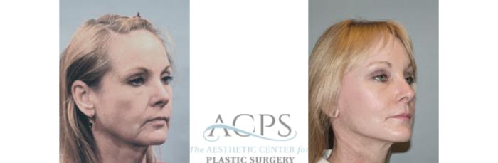 Before & After Facelift Case 1268 Oblique View: View in Houston, TX