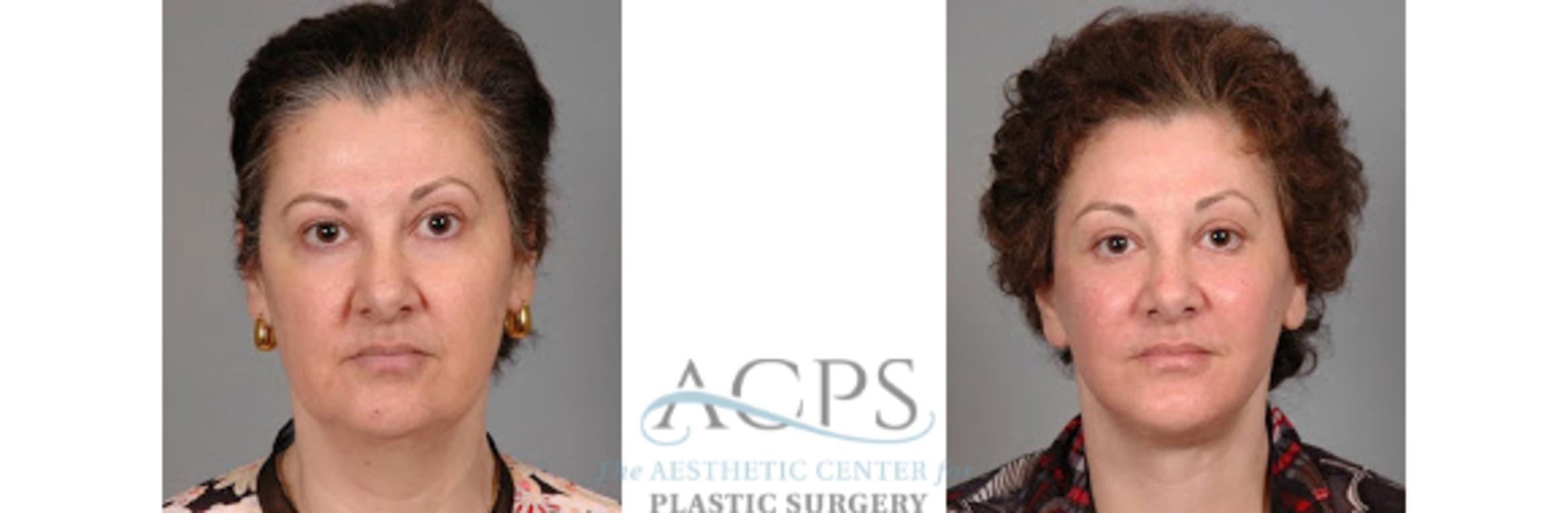 Before & After Facelift Case 1269 Front View: View in Houston, TX