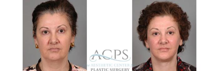 Before & After Facelift Case 1269 Front View: View in Houston, TX
