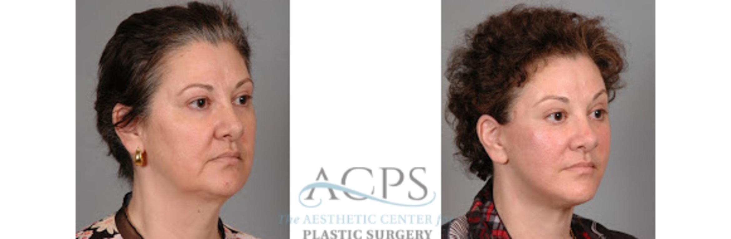 Before & After Facelift Case 1269 Oblique View: View in Houston, TX