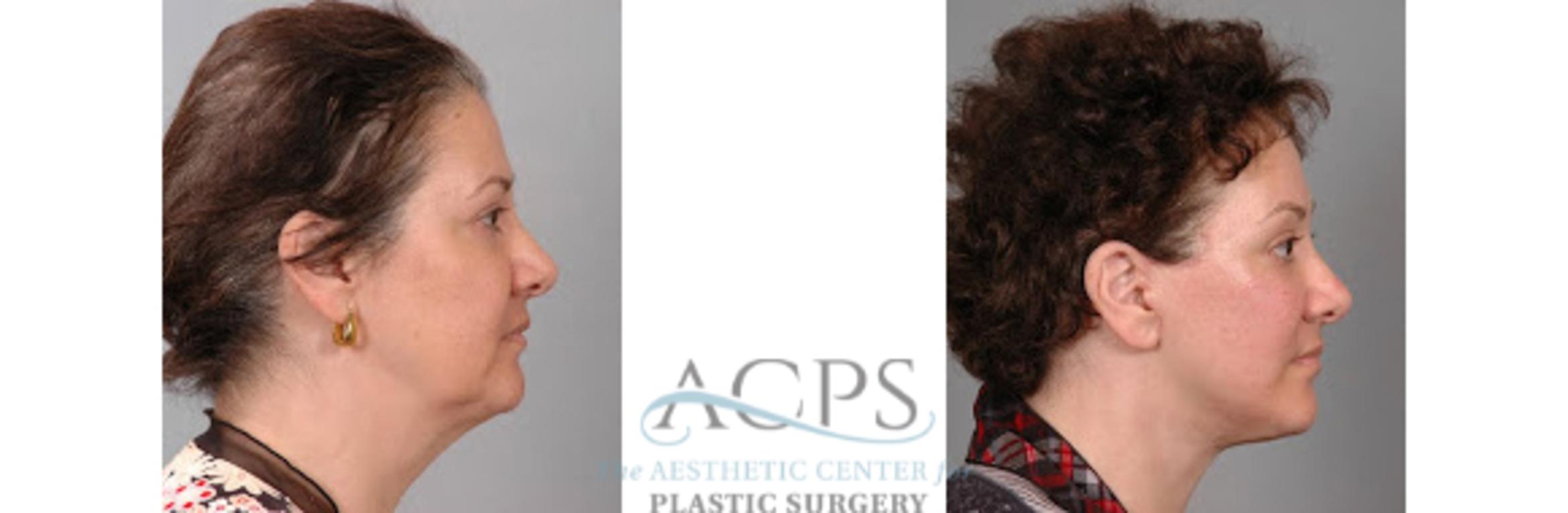 Before & After Facelift Case 1269 Side View: View in Houston, TX