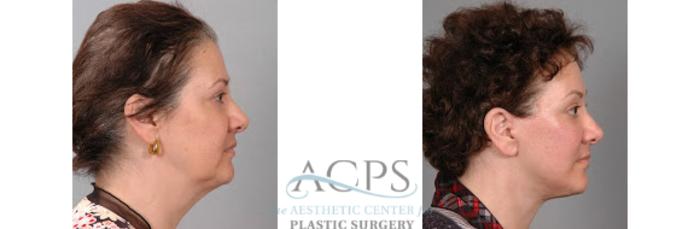 Before & After Facelift Case 1269 Side View: View in Houston, TX