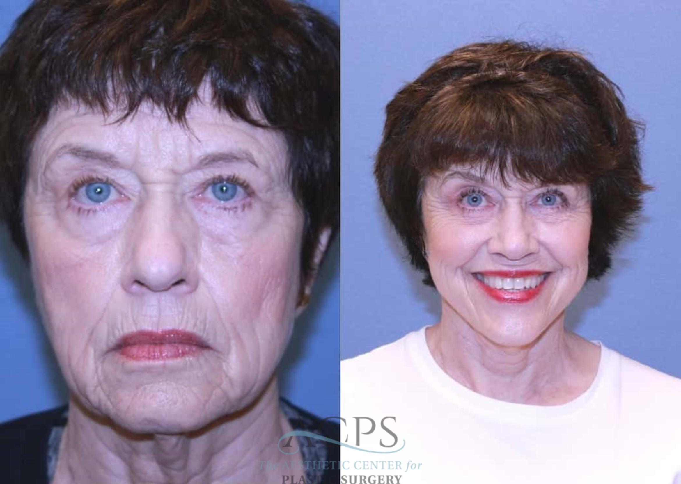 Before & After Facelift Case 1443 Front View in Houston, TX