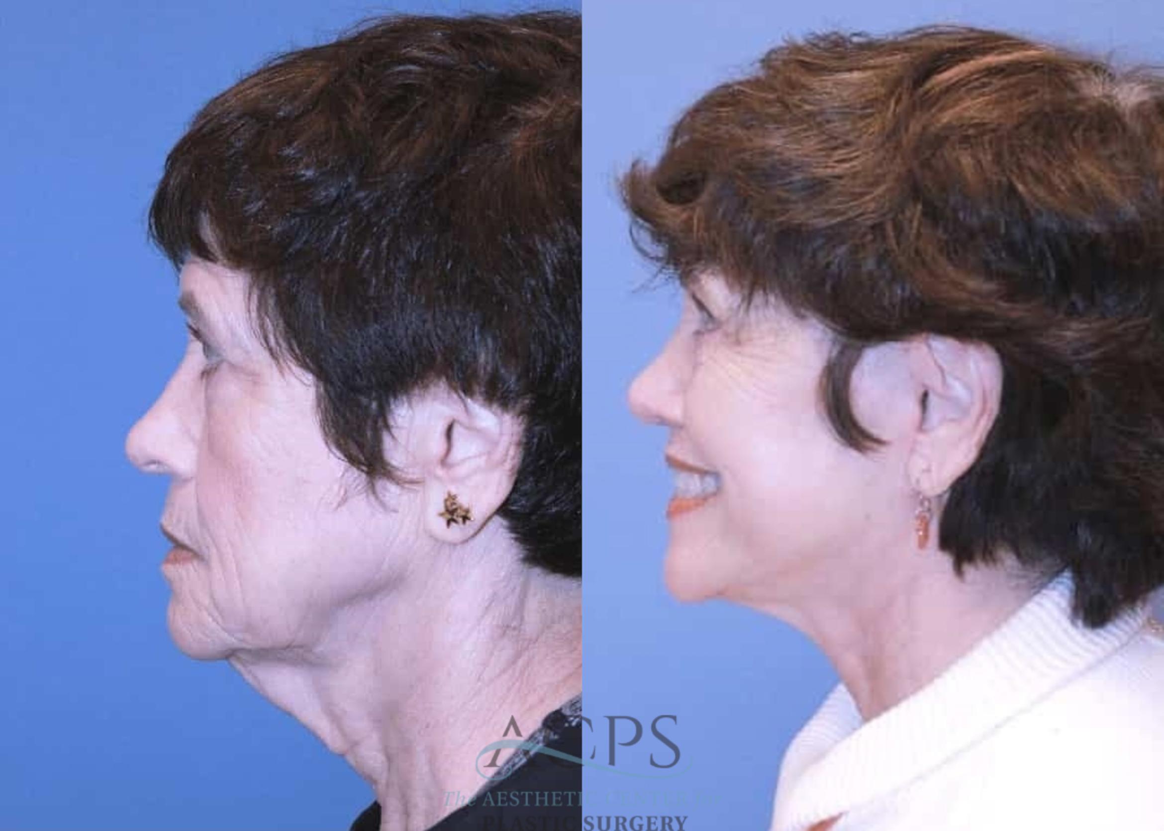 Before & After Facelift Case 1443 Left Side View in Houston, TX