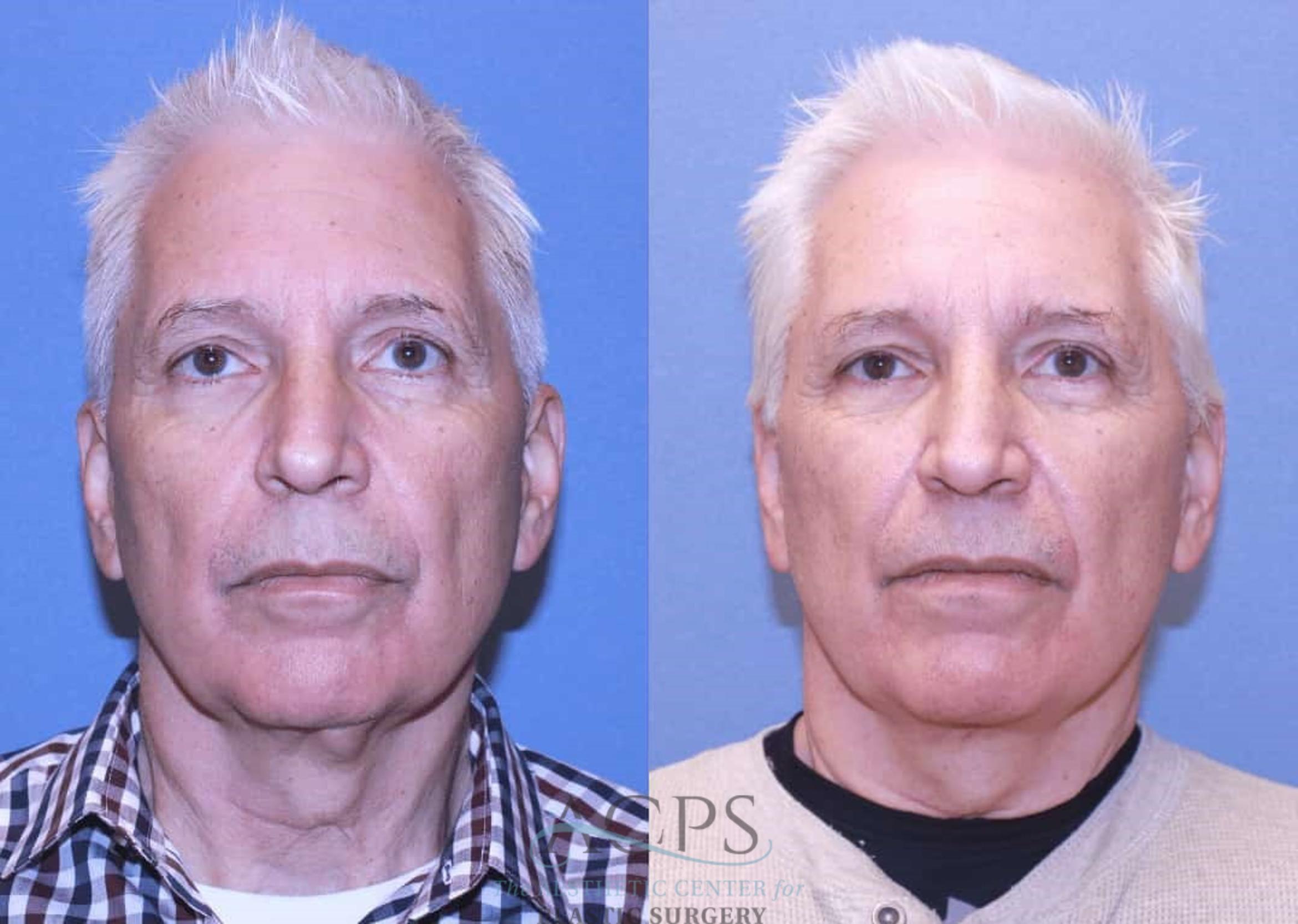 Before & After Facelift Case 1444 Front View in Houston, TX