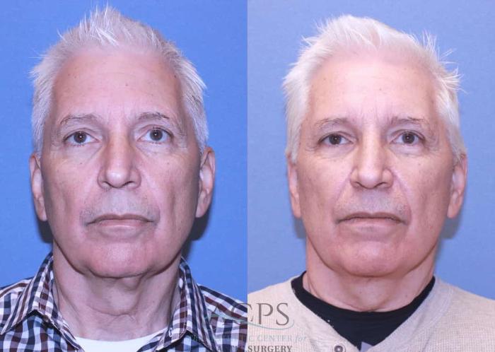 Before & After Facelift Case 1444 Front View in Houston, TX