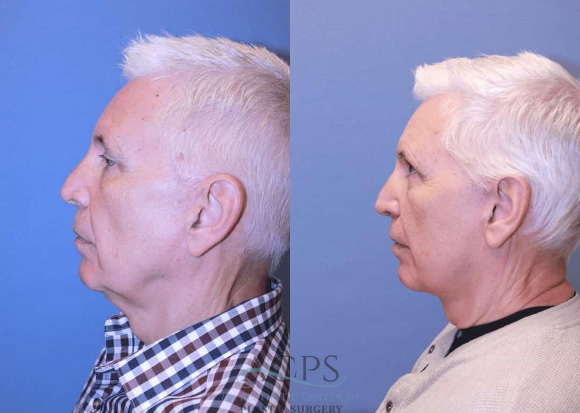 Before & After Facelift Case 1444 Left Side View in Houston, TX