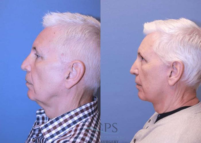 Before & After Facelift Case 1444 Left Side View in Houston, TX