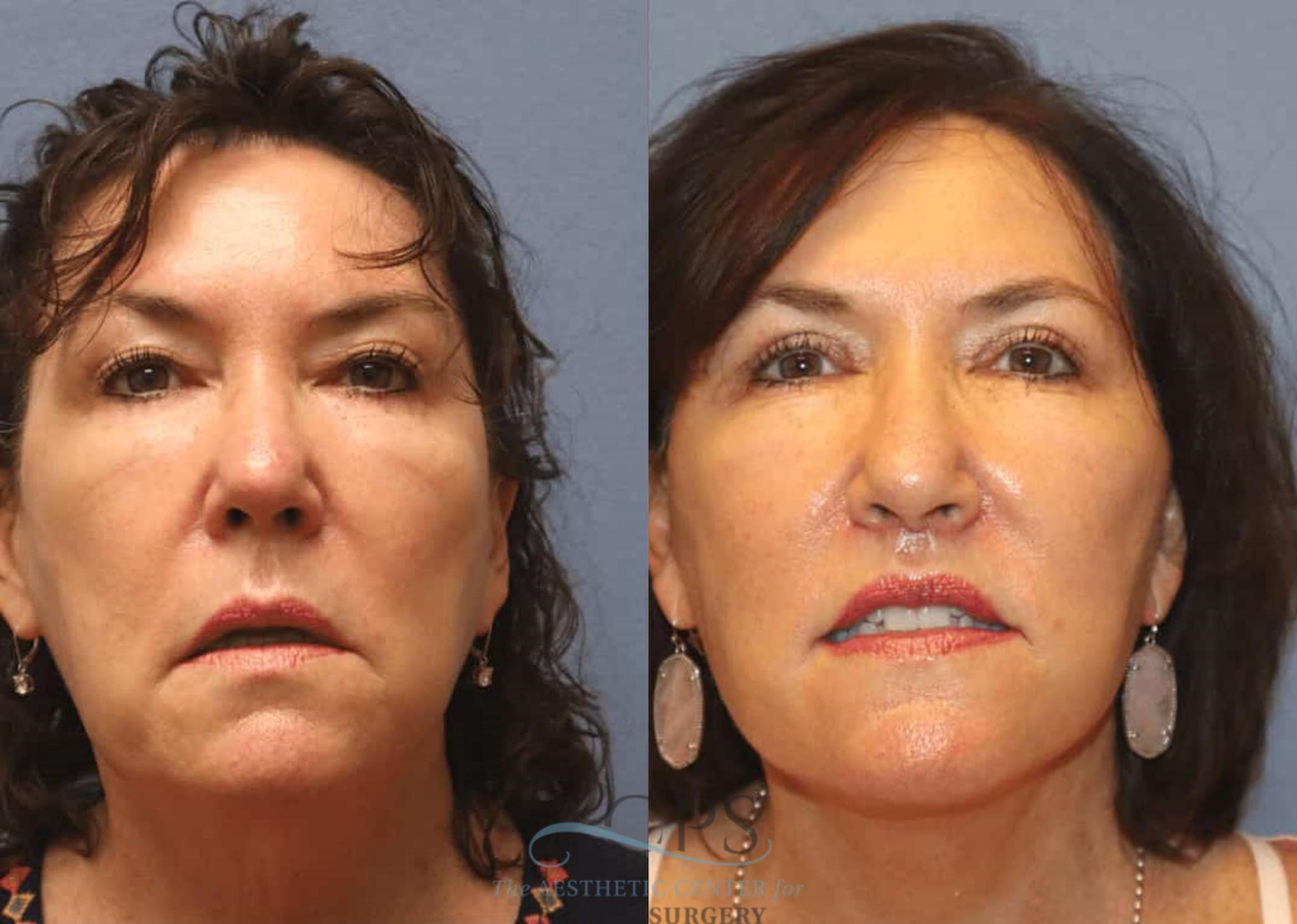 Before & After Facelift Case 1445 Front View in Houston, TX