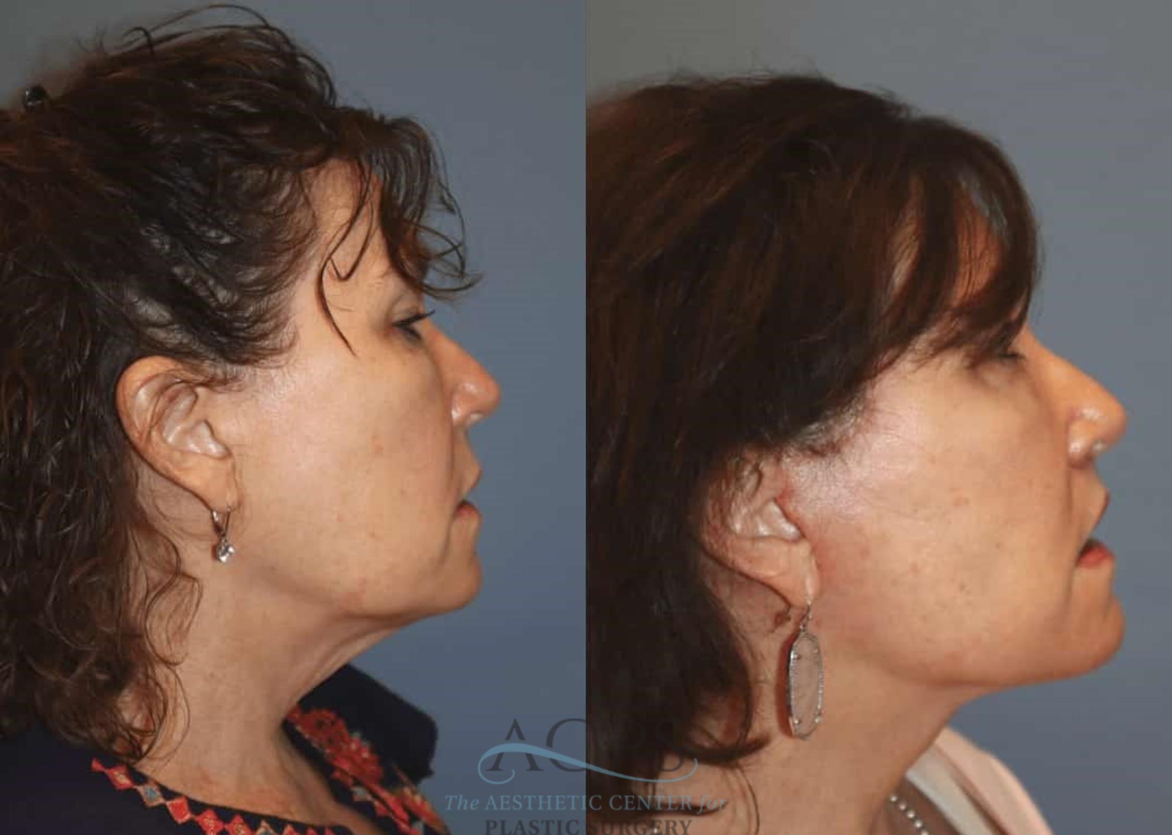 Before & After Facelift Case 1445 Right Side View in Houston, TX
