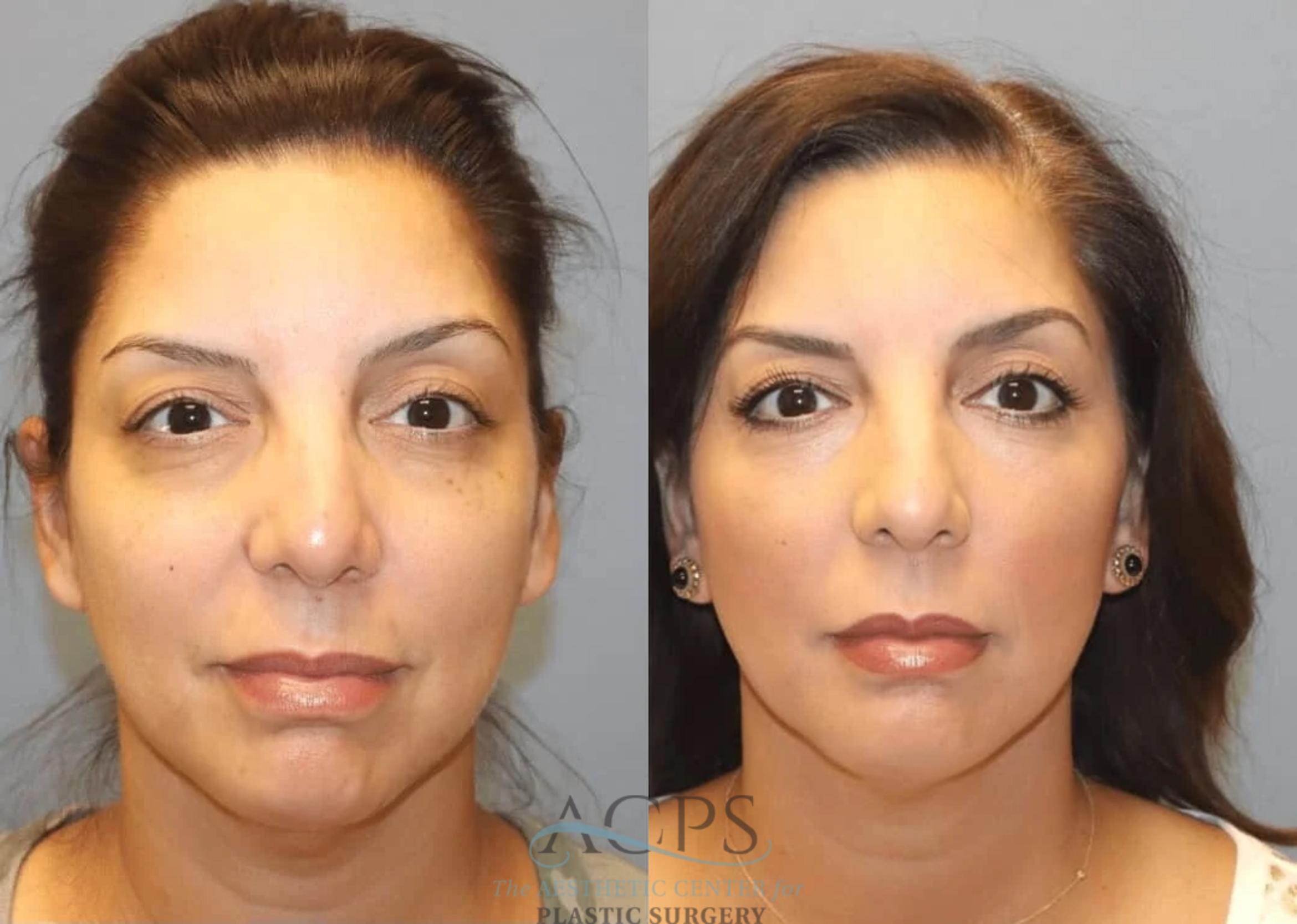 Before & After Facelift Case 1446 Front View in Houston, TX