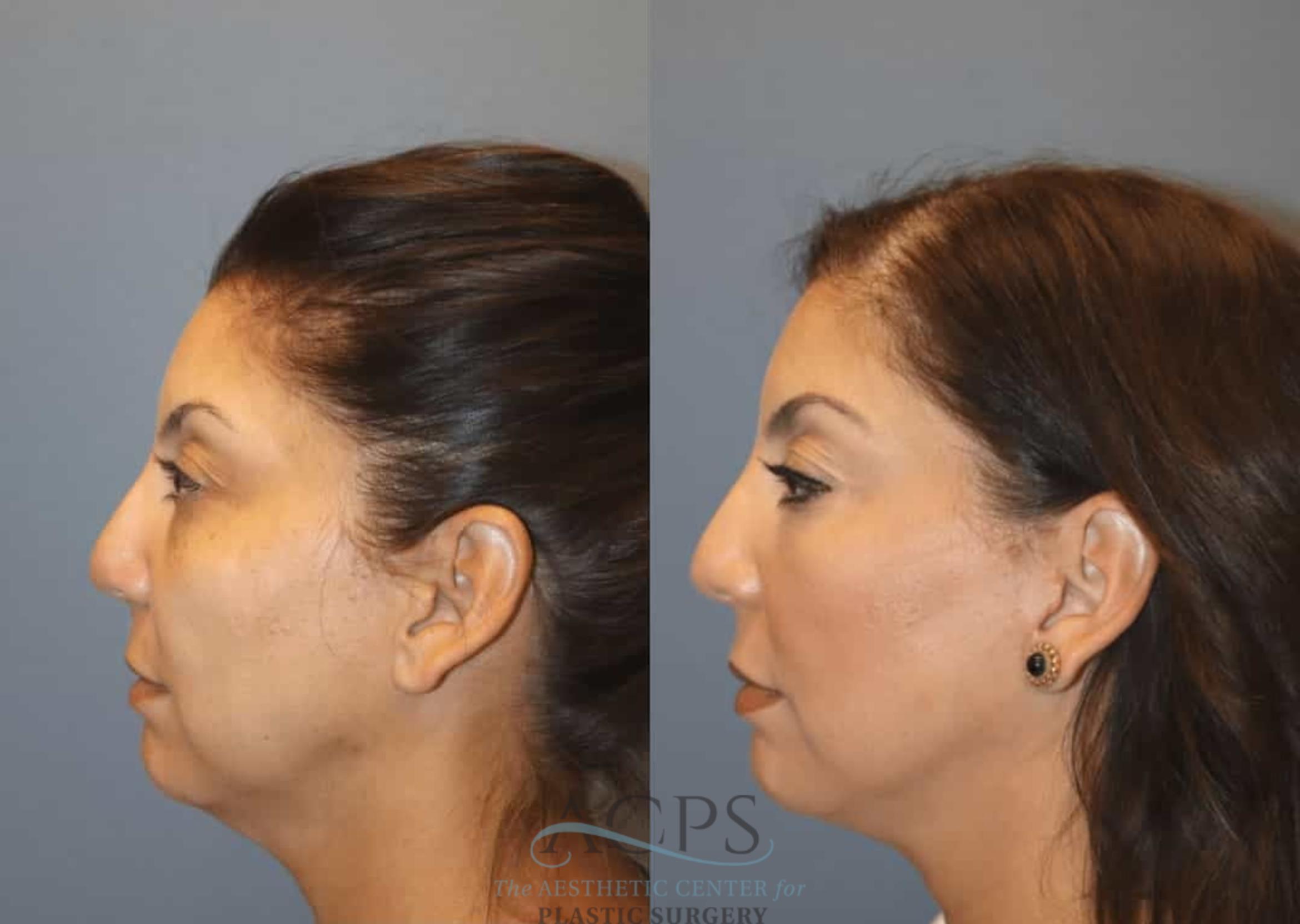Before & After Facelift Case 1446 Left Side View in Houston, TX
