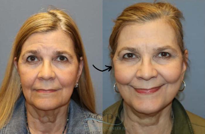 Before & After Facelift Case 1447 Front View in Houston, TX