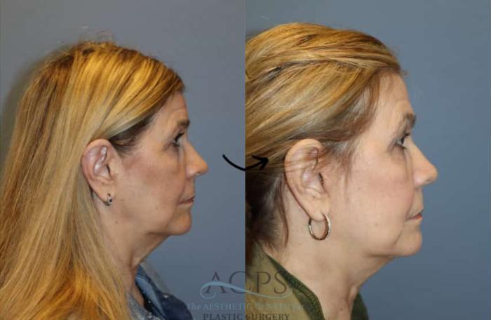 Before & After Facelift Case 1447 Right Side View in Houston, TX