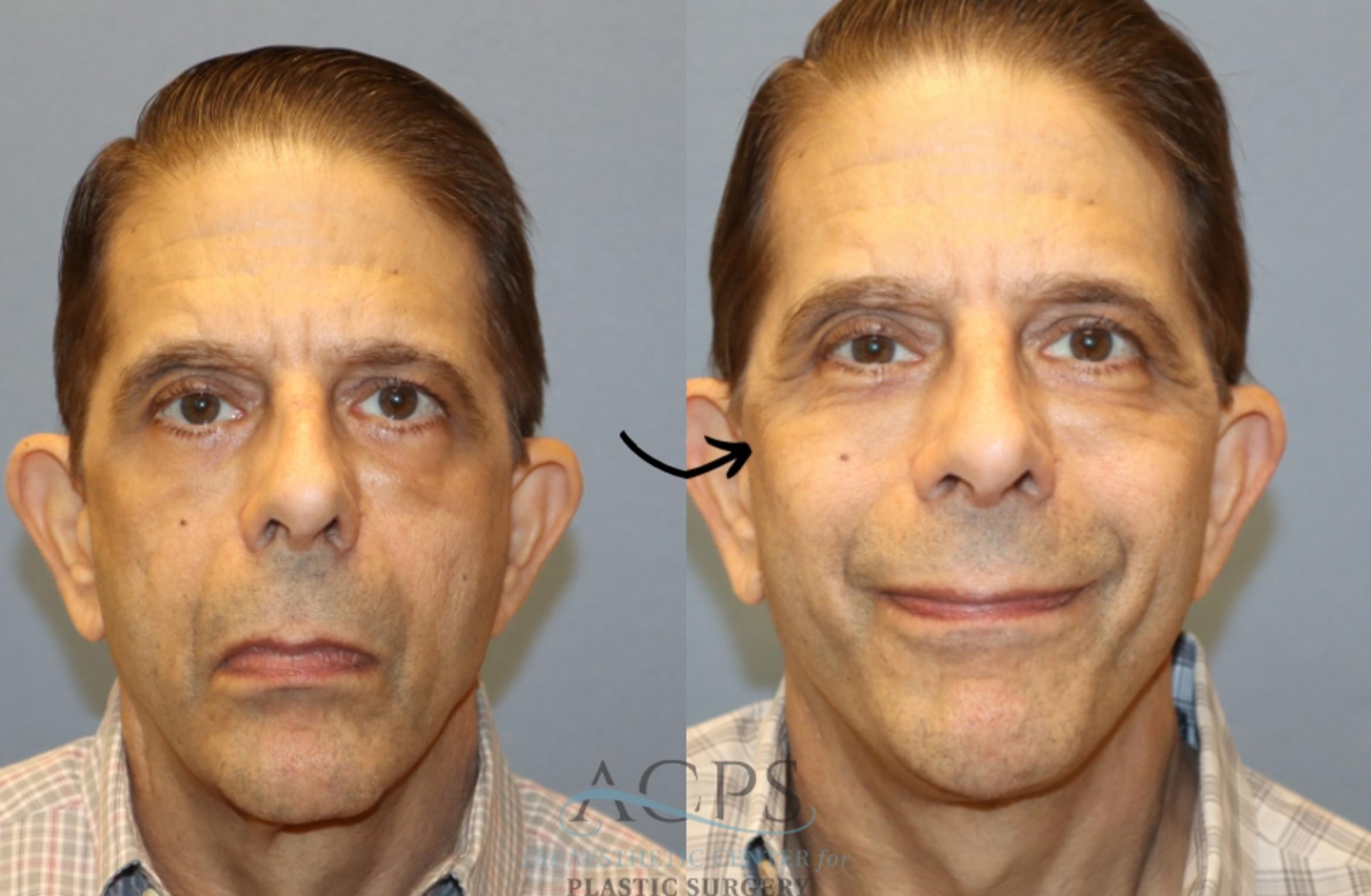 Before & After Facelift Case 1448 Front View in Houston, TX