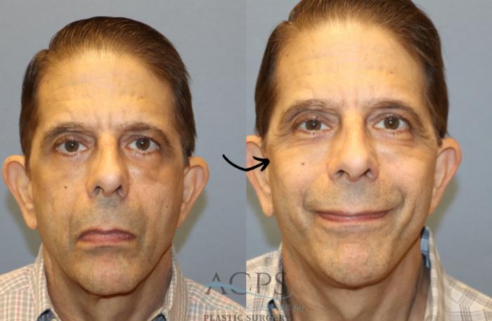 Before & After Facelift Case 1448 Front View in Houston, TX