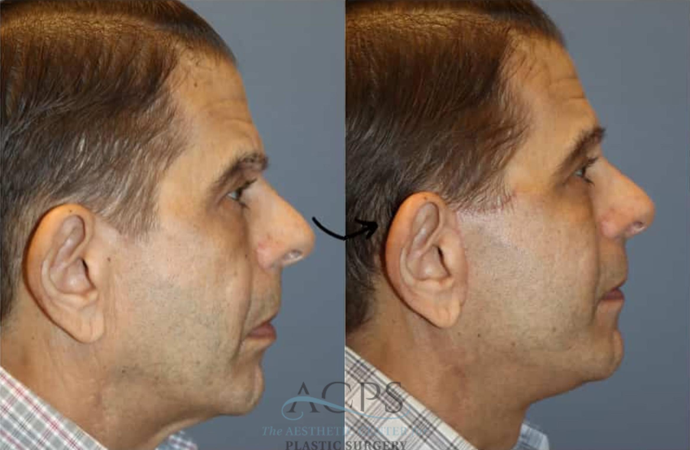 Before & After Facelift Case 1448 Right Side View in Houston, TX
