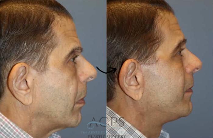 Before & After Facelift Case 1448 Right Side View in Houston, TX