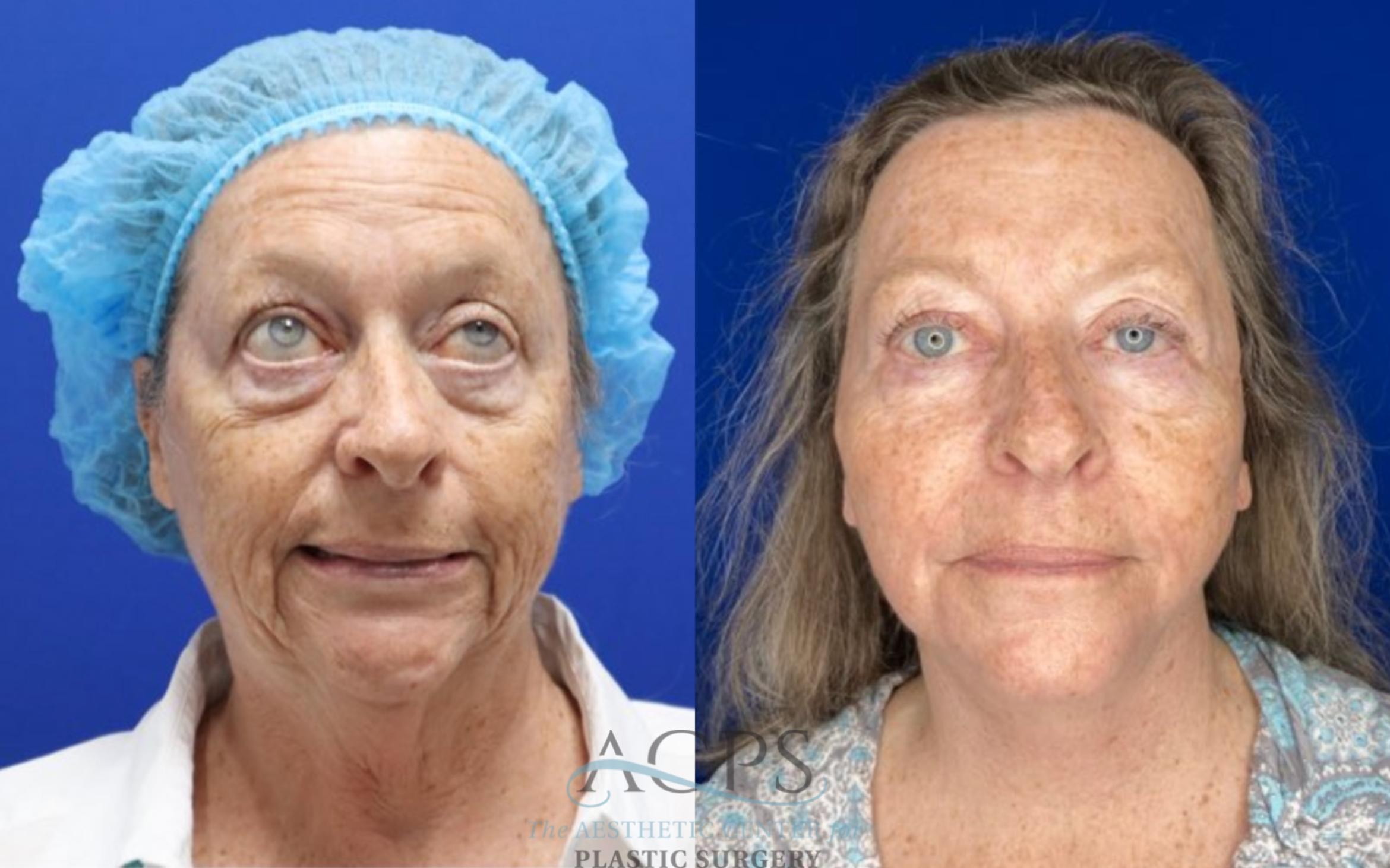 Before & After Facelift Case 1500 Front View in Houston, TX