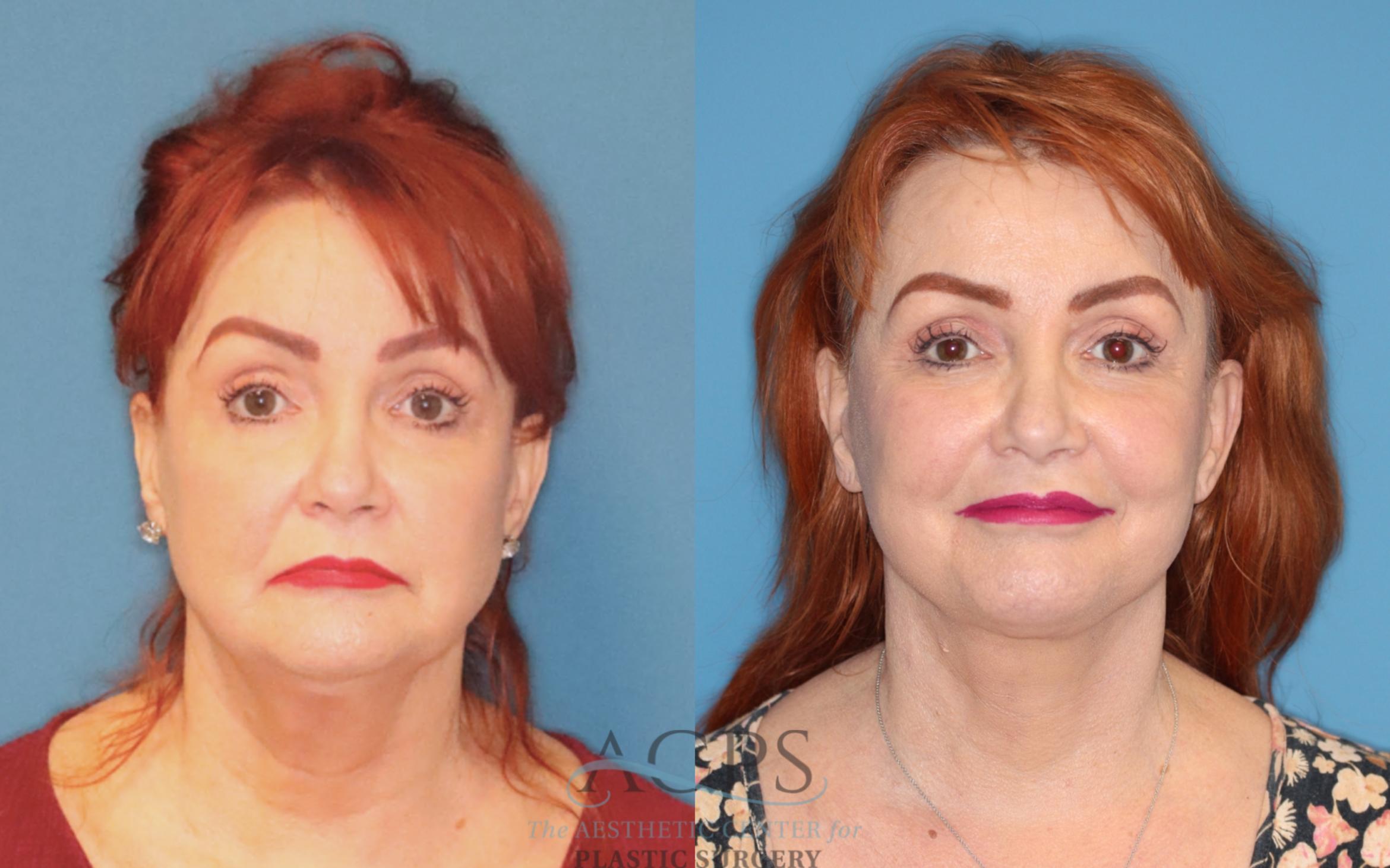 Before & After Facelift Case 1501 Front View in Houston, TX