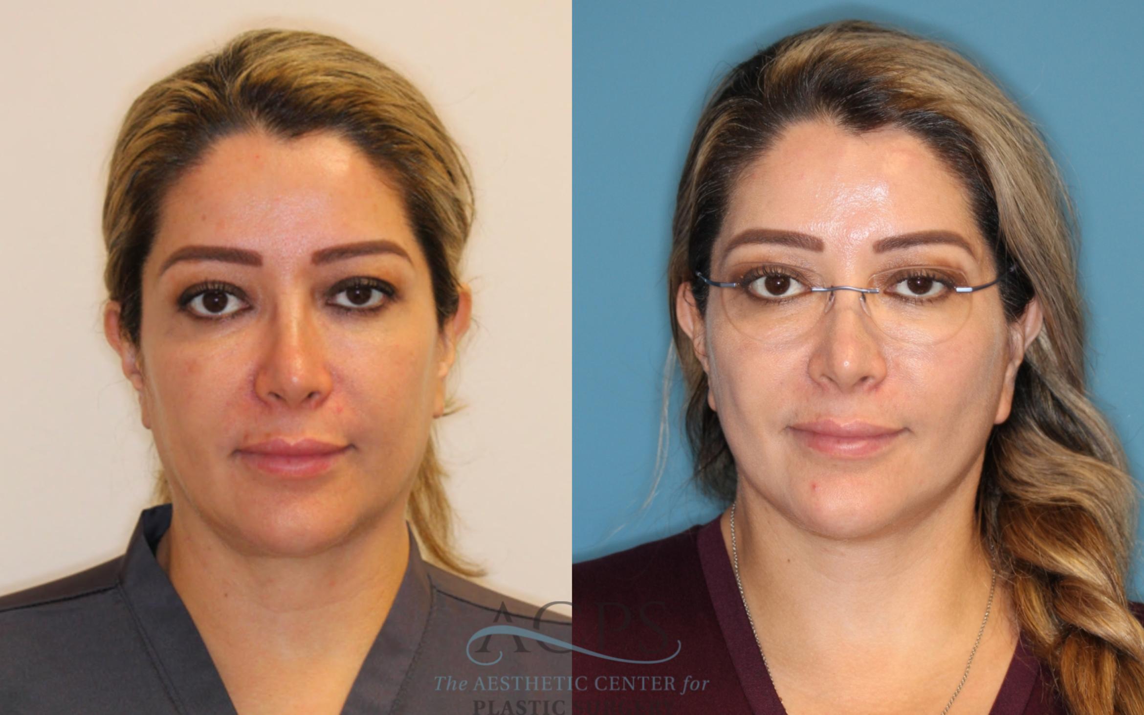 Before & After Facelift Case 1502 Front View in Houston, TX