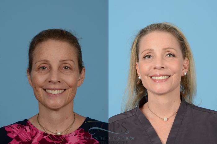 Before & After Neck Lift Case 1517 Front Smiling View in Houston, TX