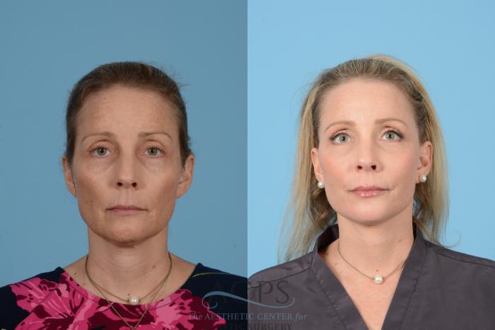 Before & After Neck Lift Case 1517 Front View in Houston, TX