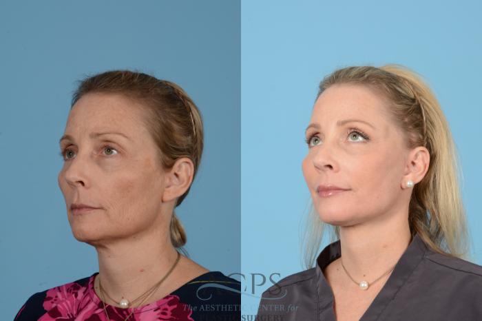 Before & After Neck Lift Case 1517 Left Oblique View in Houston, TX