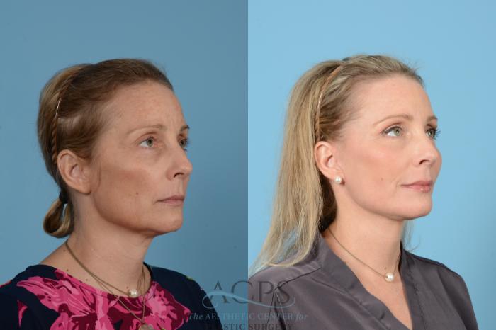 Before & After Neck Lift Case 1517 Right Oblique View in Houston, TX