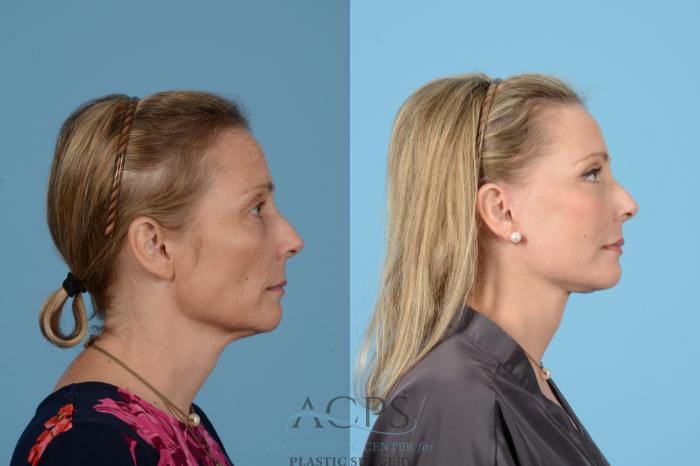 Before & After Neck Lift Case 1517 Right Side View in Houston, TX