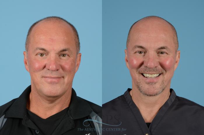 Before & After Facelift Case 1534 Front Smiling View in Houston, TX