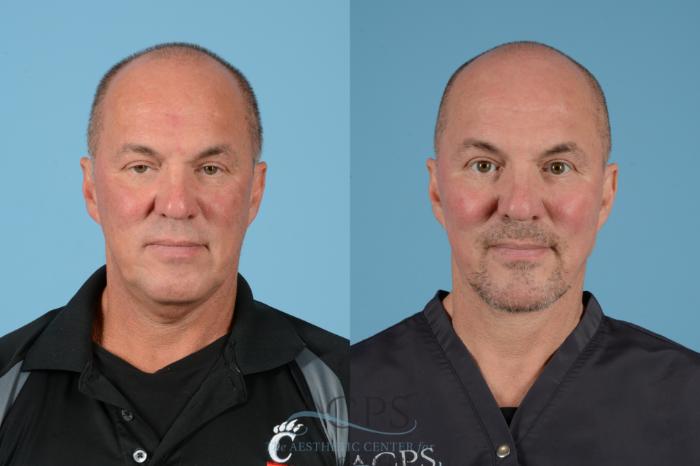 Before & After Facelift Case 1534 Front View in Houston, TX