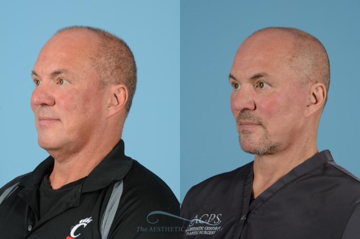 Before & After Facelift Case 1534 Left Oblique View in Houston, TX