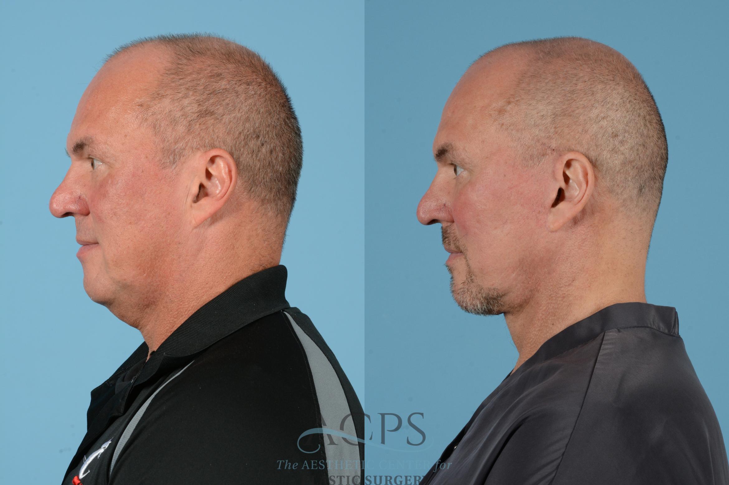 Before & After Facelift Case 1534 Left Side View in Houston, TX