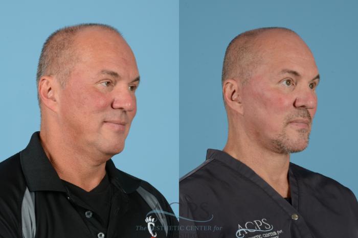 Before & After Facelift Case 1534 Right Oblique View in Houston, TX