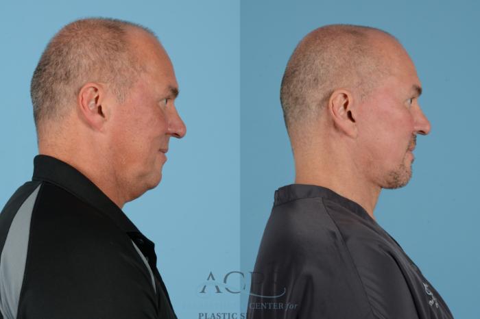 Before & After Facelift Case 1534 Right Side View in Houston, TX