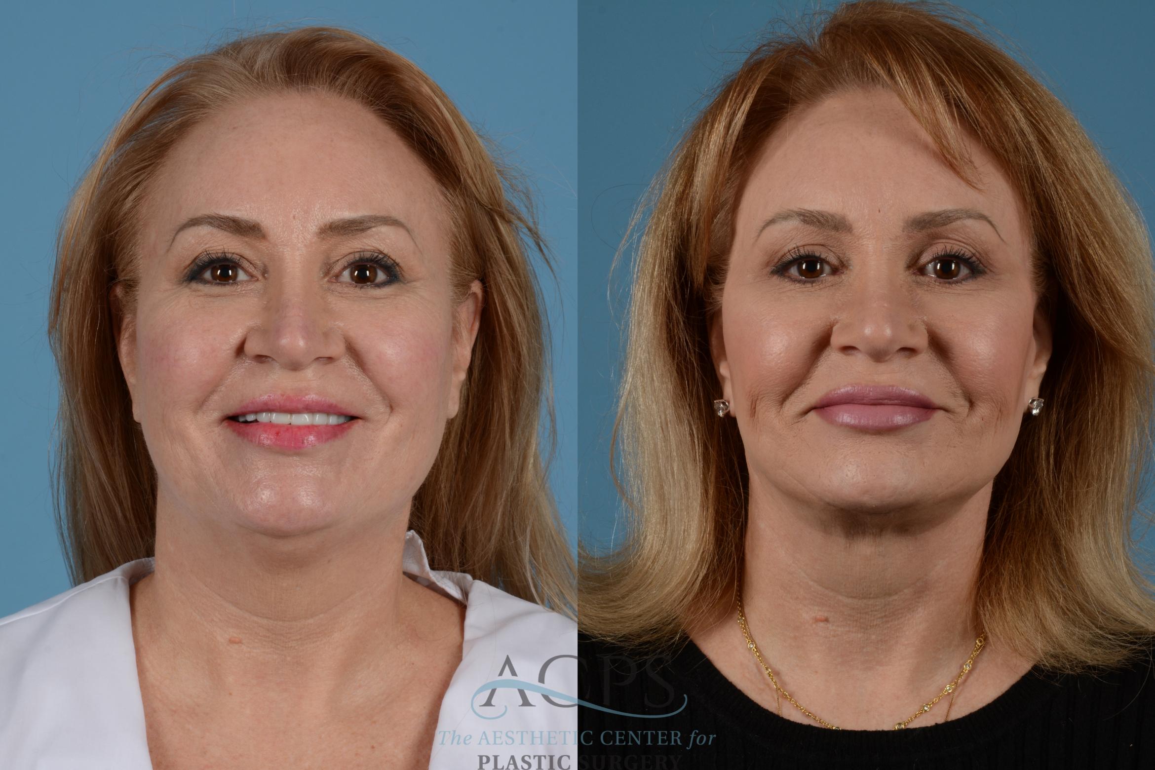 Before & After Facelift Case 1535 Front Smiling View in Houston, TX