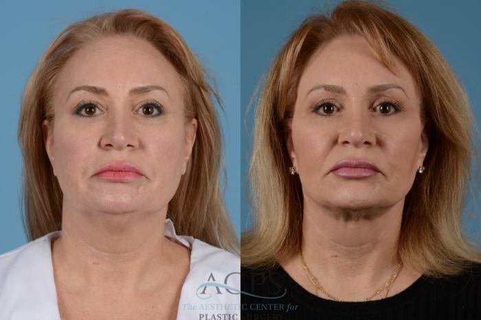 Before & After Facelift Case 1535 Front View in Houston, TX