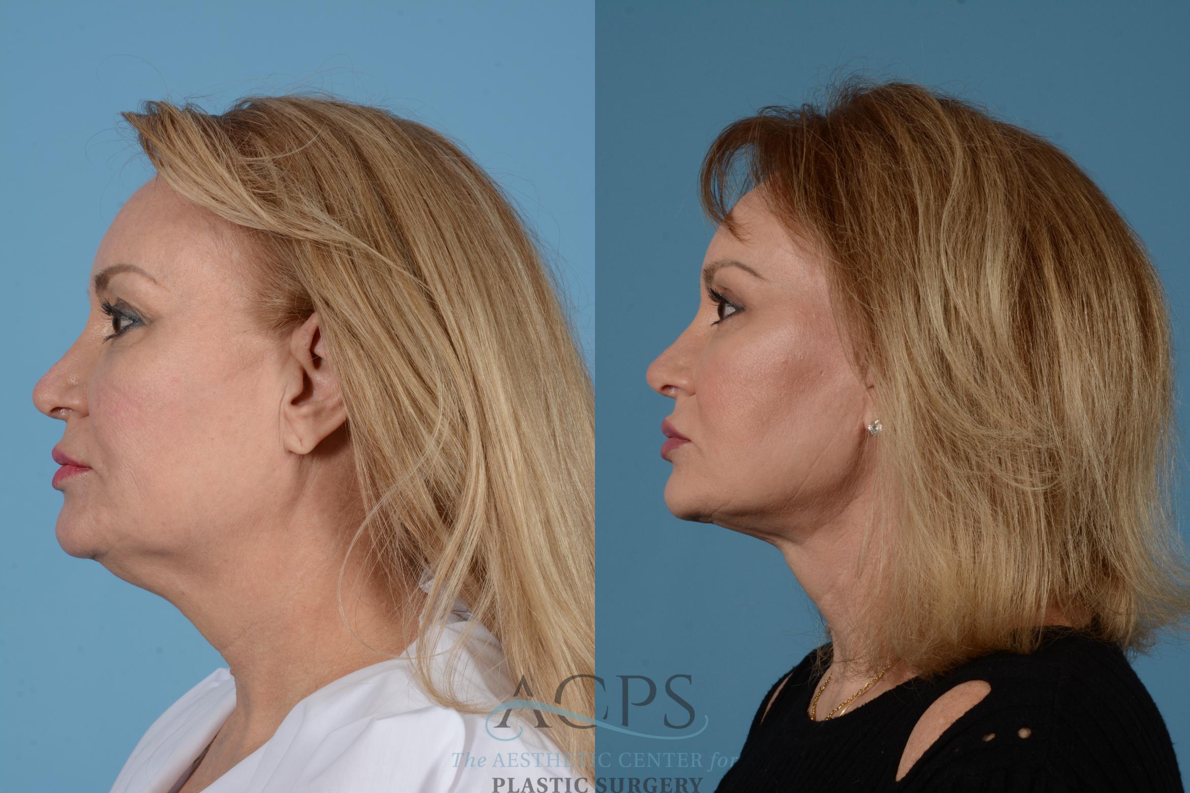 Before & After Facelift Case 1535 Left Side View in Houston, TX