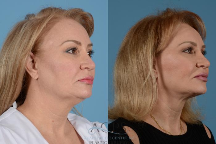 Before & After Facelift Case 1535 Right Oblique View in Houston, TX