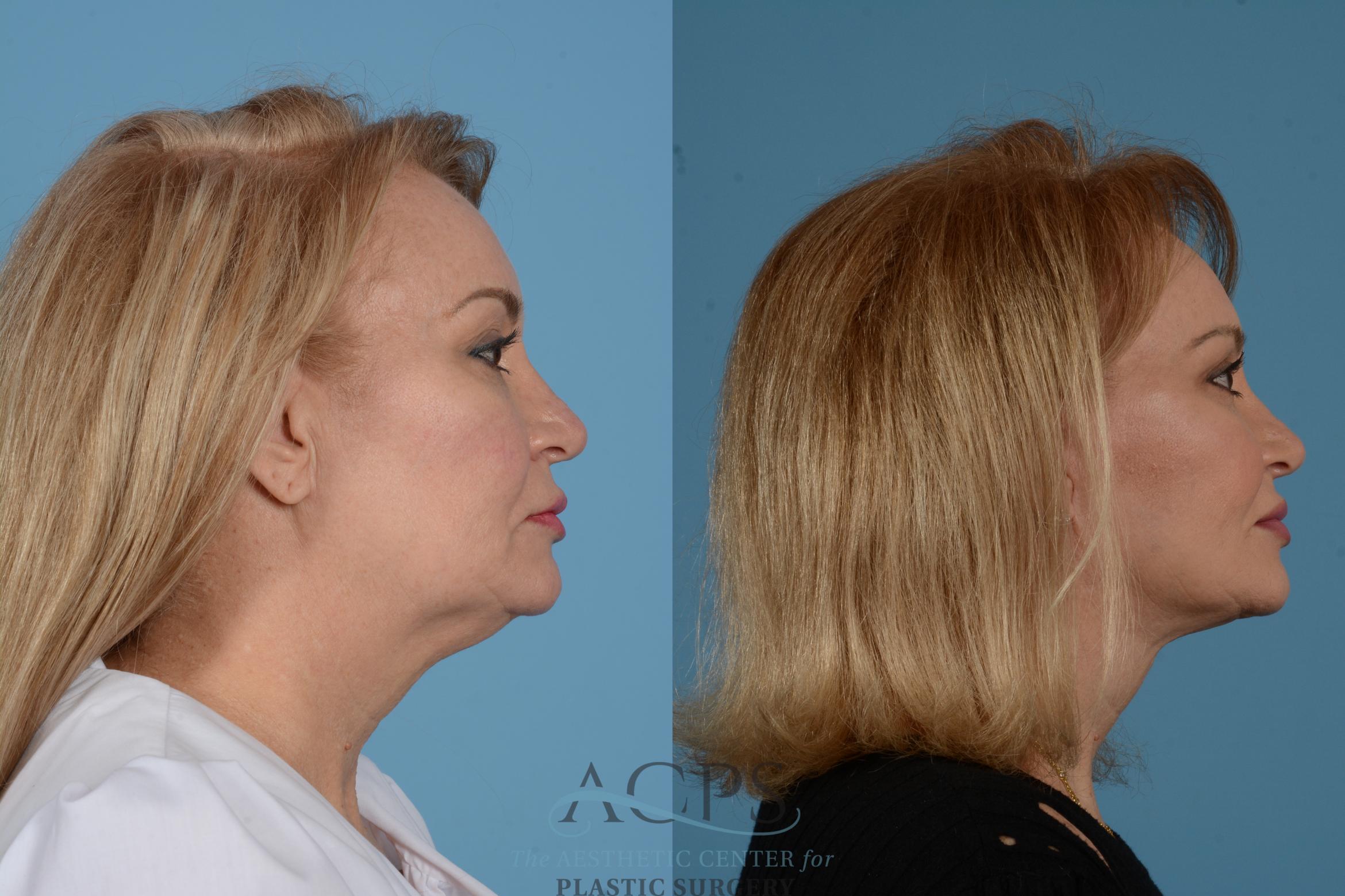 Before & After Facelift Case 1535 Right Side View in Houston, TX