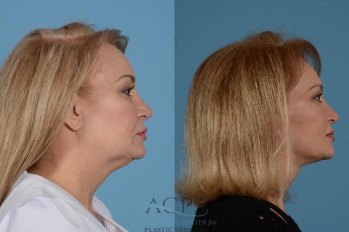Before & After Facelift Case 1535 Right Side View in Houston, TX