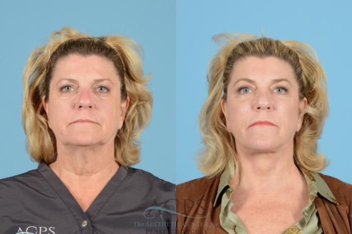 Before & After Brow Lift Case 1539 Front View in Houston, TX