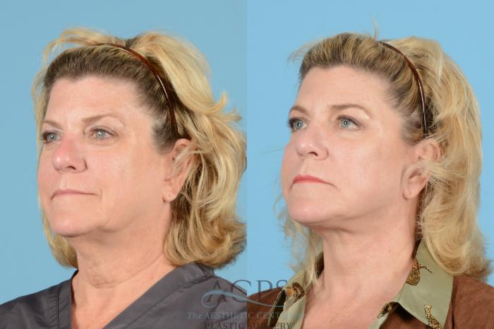 Before & After Brow Lift Case 1539 Left Oblique View in Houston, TX