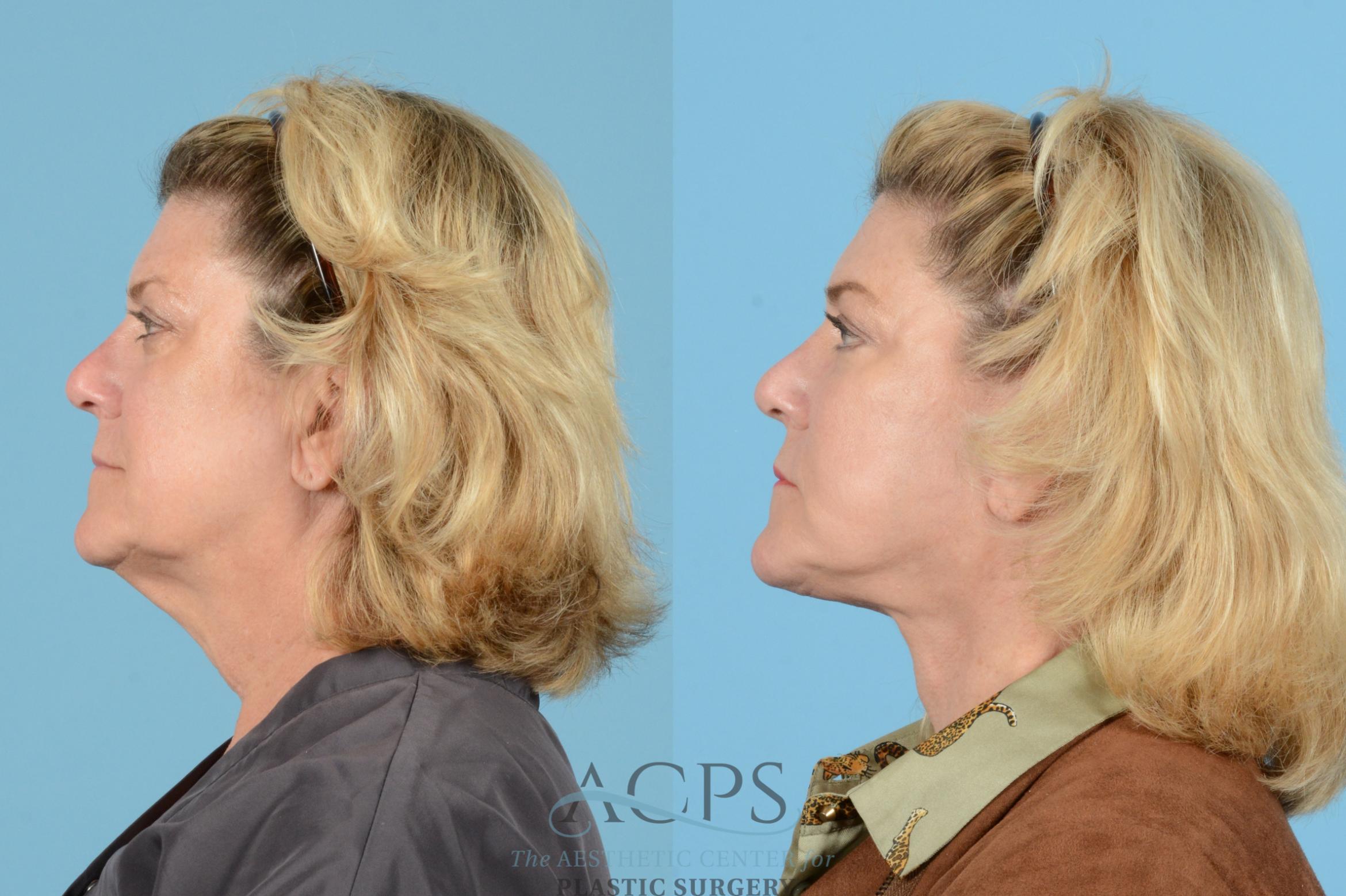 Before & After Brow Lift Case 1539 Left Side View in Houston, TX