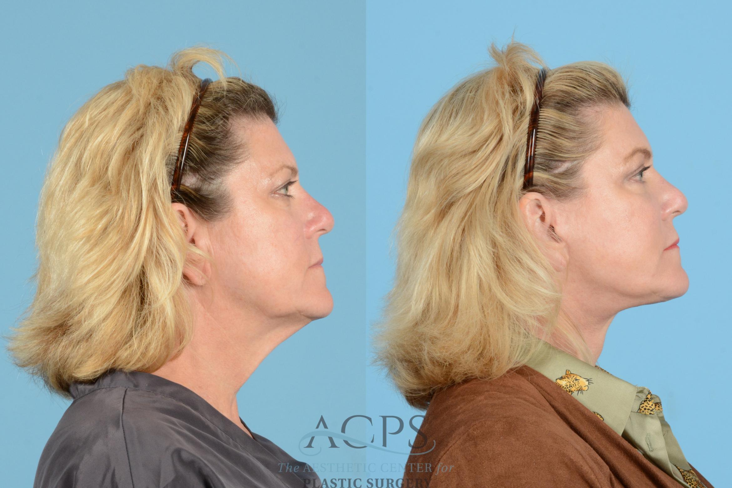 Before & After Brow Lift Case 1539 Right Side View in Houston, TX